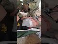 Echo 24-35 68W vid 88 3rd PLT: Triage Treating an Abdominal Evisceration