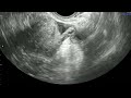 11 femvue challenging case example 4 – tubal spasm