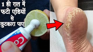 कोलगेट का ये तरीका 1 ही रात में फटी एड़ियों से छुटकारा दिला देगा | Cracked Heels Home Remedy