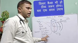 Fissure- फ़िसर कैसा भी हो। ठीक जरूर होगा। इलाज़ कैसे करें। Dr Sanjeet Sahu 8858287131 Lucknow