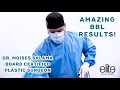 Amazing BBL Results by Dr. Salama