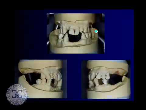 How the partial denture is to be supported?