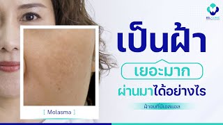 รักษาฝ้า | EP.15 | ฝ้ากระ หน้าเป็นฝ้าหนักมาก ผ่านปัญหานี้ได้อย่างไร | BSL Clinic