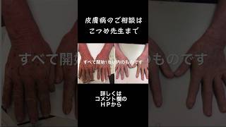 アトピー、ニキビ、乾癬など皮膚病の相談受け付け中