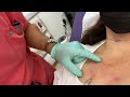 hyper diluted radiesse treatment of chest area