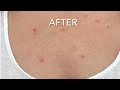 hyper diluted radiesse treatment of chest area