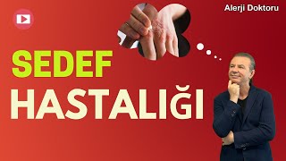 Sedef Hastalığı - Alerji Doktoru Prof. Dr. Ahmet Akçay