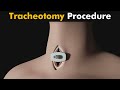 How Tracheotomy is performed? | Tracheotomy 3D Animation (Urdu/Hindi)