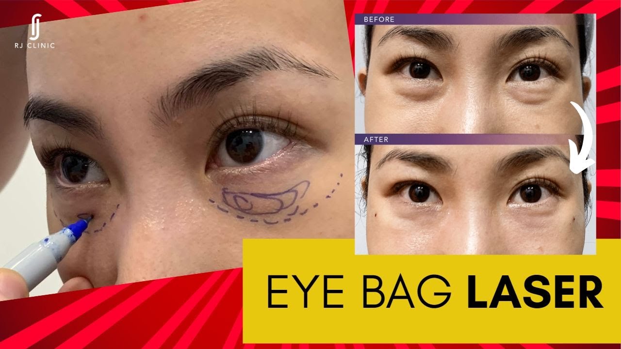 Non Surgical Eye Bag Laser Treatment Say Goodbye To Under Eye Bags