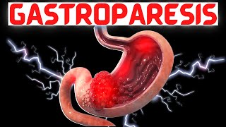 Gastroparesis | What is it?