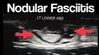 Nodular Fasciitis