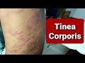 Tinea Corporis - WideSpread