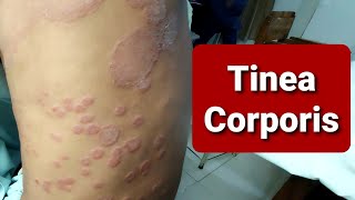 Tinea Corporis - WideSpread