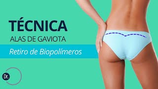 Técnica alas de gaviota - Retiro de biopolímeros