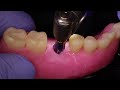 step by step dental implant procedure back molar