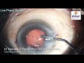 pxf glaucoma deep ac very hard cataract