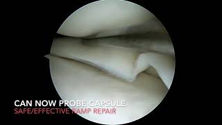 Knee Meniscal Ramp Repair