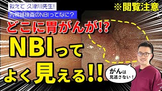 見えにくいがんも見逃さない！ 胃カメラ検査のNBIってここがスゴい！　教えて久津川先生 No47