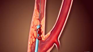 Voyage Through the Veins: An Animated Exploration of Carotid Angioplasty and Stenting