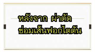 รู้ลึกเส้นฟอกไต  ตอน ประสบการณ์ผู้ป่วยเส้นตัน มาเร็ว แก้ทันใช้วันต่อไปได้ทันที