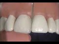 diastema closure using free hand technique