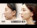 allidatv 💯즉각적인 변화 실화 수술없이 5분만에 높아지는 코👃🏻