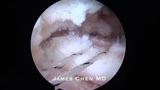 Arthroscopic Revision Repair of Massive Rotator Cuff Tear