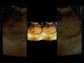 molar pregnancy#ultrasound#shorts