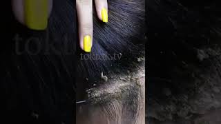 Dandruff flake removal