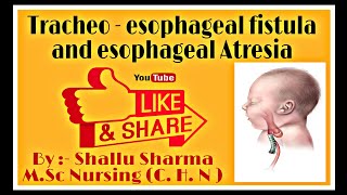 Tracheo - esophageal fistula and Esophageal atresia|| TEF and EA || Nursing lecture