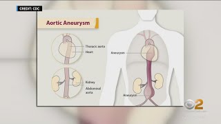 American Heart Month: Aortic aneurysms