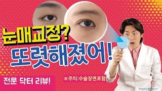 눈매교정(주의:수술장면포함) 또렷하게 알려줄게 - 눈이 커지는 마법!