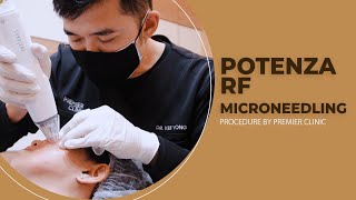 Potenza RF Microneedling - Premier Clinic Malaysia