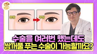 쌍꺼풀수술, 여러번 했는데도 쌍꺼풀 푸는 수술이 가능할까요?