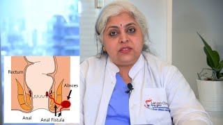 Anal Fistula cure without surgery by Video assisted Laser Fiber Ablation - Dr Phanipriya G