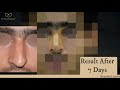 Rhinoplasty Testimonial Result After 7 Days | Happy Patient | Dr. Monisha Kapoor Aesthetics