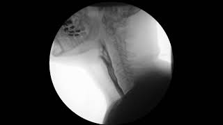 Modified Barium Swallow Exam