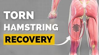 Hamstring Tear? How long you'll REALLY be out for. Do THIS Now! (Science-Backed)