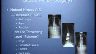 Update on Management of Common Pediatric Spinal Deformities