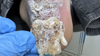 Shock! Removing a Massive Layer of Warts – You Have to See This!