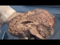 orientation the planes of the brain neuroanatomy video lab brain dissections