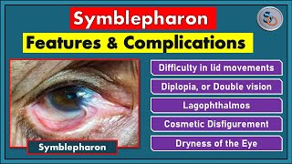 Symblepharon- Clinical Features and Complications.