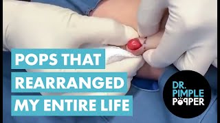 Different Shades of Butter! Dr Pimple Popper's Pops That Rearranged My Entire Life