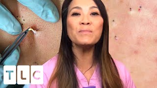 Exclusive Pops: Buttery Cyst Extraction | Dr. Pimple Popper: This Is Zit