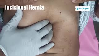 INCISIONAL HERNIA - HOW DOES IT LOOK LIKE ?