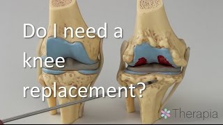 Do You Need A Knee Replacement?