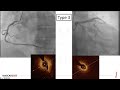 spontaneous coronary artery dissection scad update