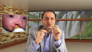 What should be done before the surgery on the cleft lip and palate? Prof. Dr. Bekir Atik