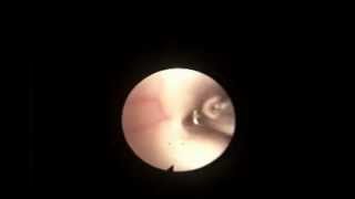 Endoscopic Transventricular Lamina Terminalis Fenestration Video 1