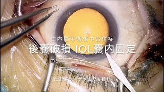 後嚢破損（白内障手術合併症）眼内レンズ（アイハンス）嚢内固定※手術動画です（編集あり）